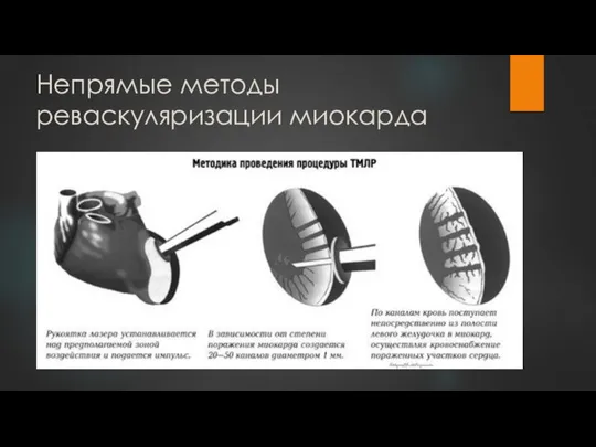 Непрямые методы реваскуляризации миокарда