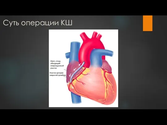 Суть операции КШ