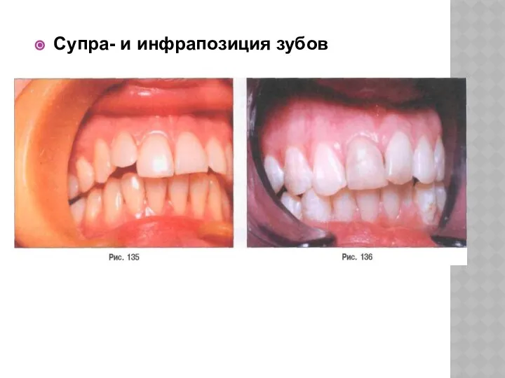 Супра- и инфрапозиция зубов