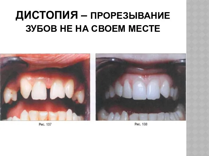 ДИСТОПИЯ – ПРОРЕЗЫВАНИЕ ЗУБОВ НЕ НА СВОЕМ МЕСТЕ