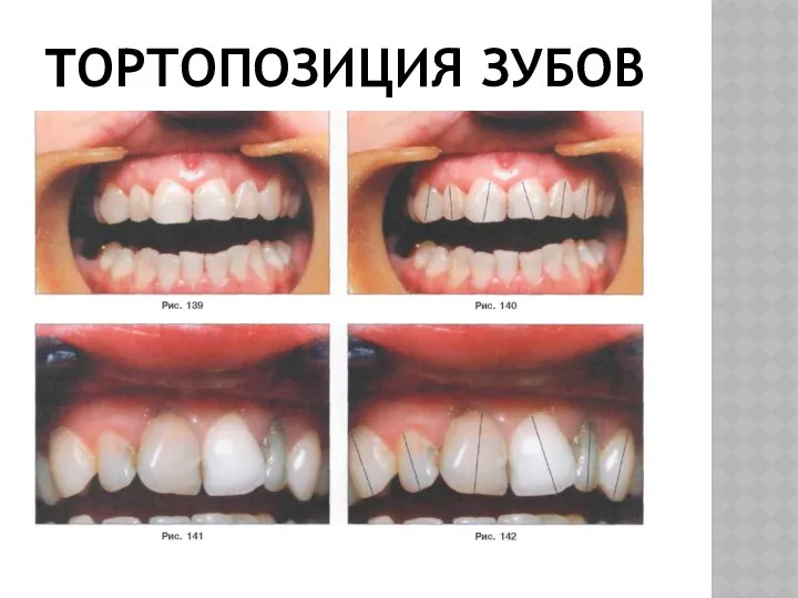 ТОРТОПОЗИЦИЯ ЗУБОВ