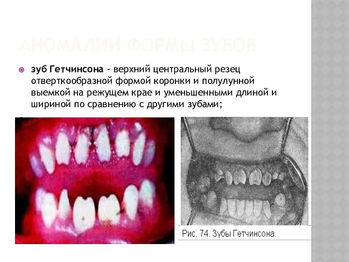 АНОМАЛИИ ФОРМЫ ЗУБОВ зуб Гетчинсона - верхний центральный резец отверткообразной формой