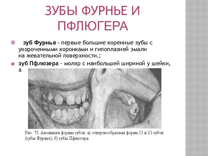 ЗУБЫ ФУРНЬЕ И ПФЛЮГЕРА зуб Фурнье - первые большие коренные зубы