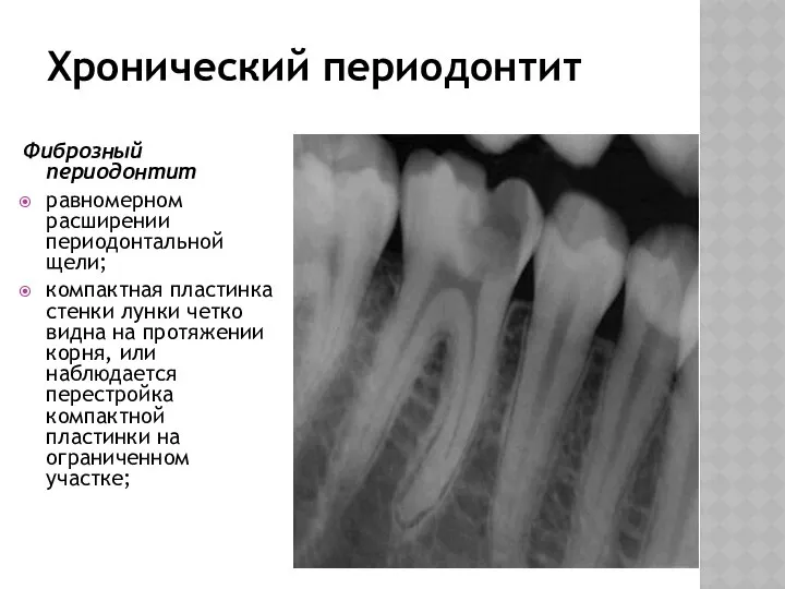 Хронический периодонтит Фиброзный периодонтит равномерном расширении периодонтальной щели; компактная пластинка стенки