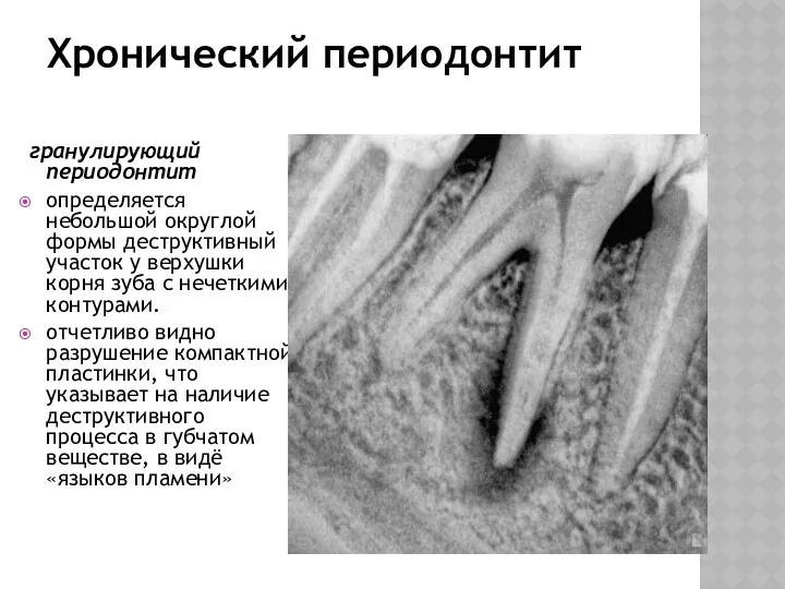 Хронический периодонтит гранулирующий периодонтит определяется небольшой округлой формы деструктивный участок у
