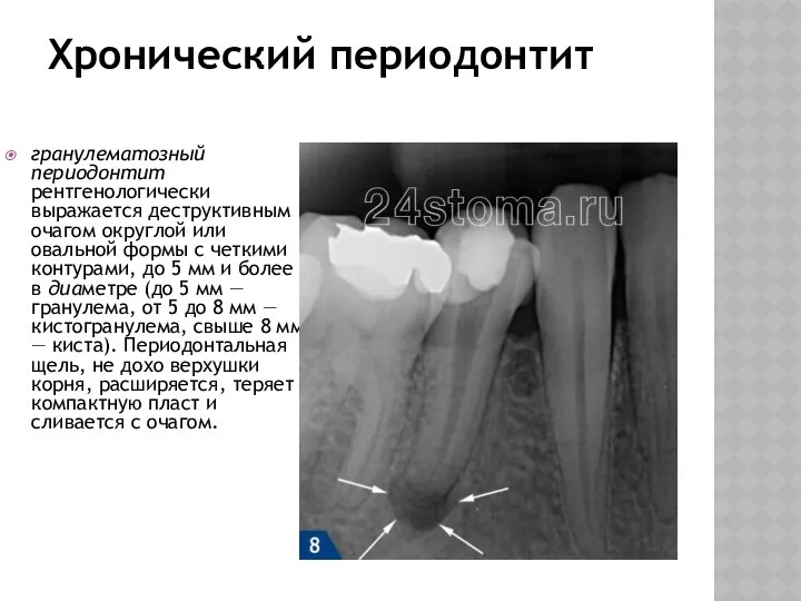 Хронический периодонтит гранулематозный периодонтит рентгенологически выражается деструктивным очагом округлой или овальной