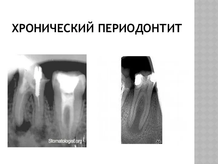 ХРОНИЧЕСКИЙ ПЕРИОДОНТИТ