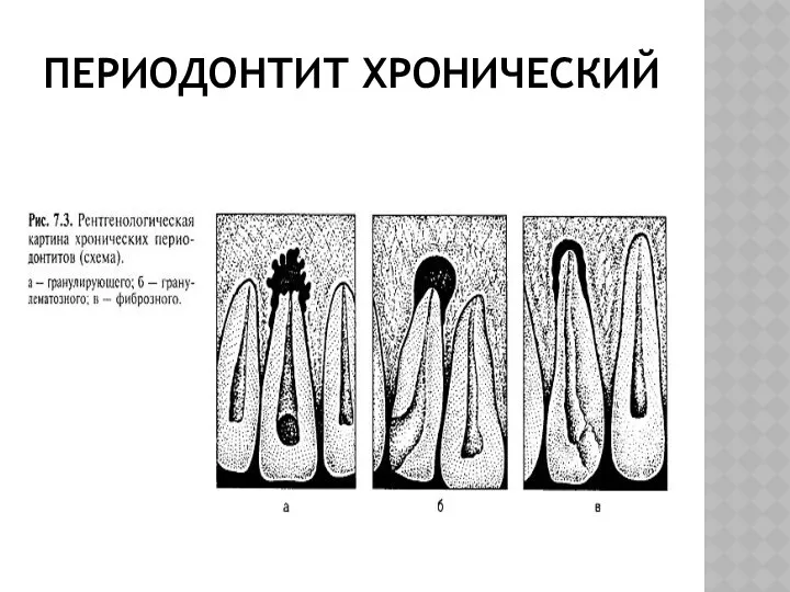 ПЕРИОДОНТИТ ХРОНИЧЕСКИЙ