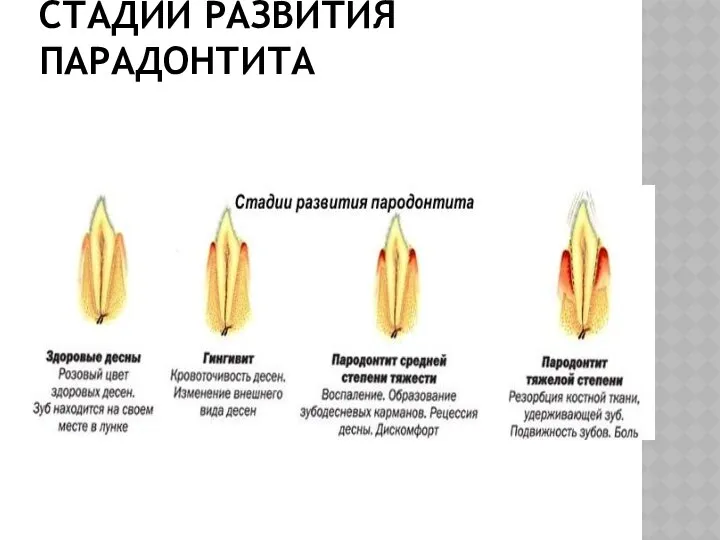 СТАДИИ РАЗВИТИЯ ПАРАДОНТИТА