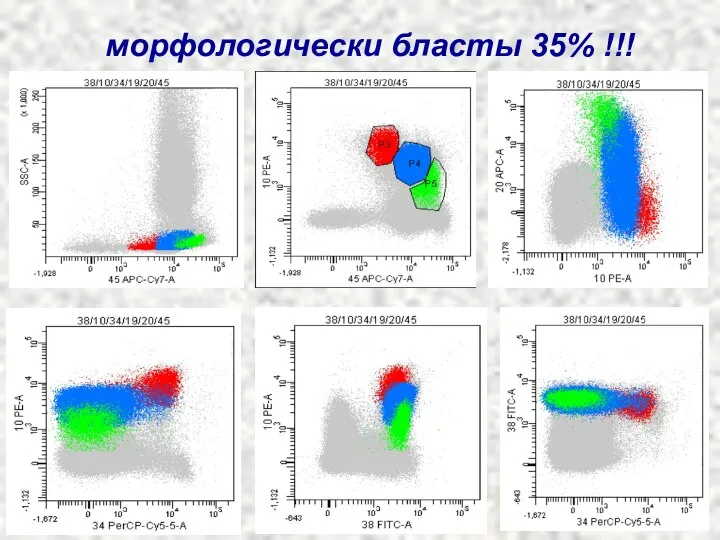 морфологически бласты 35% !!!