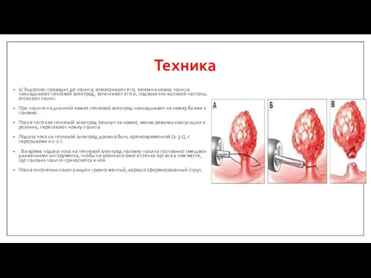 Техника 1) Эндоскоп проводят до полипа, осматривают его, затем на ножку