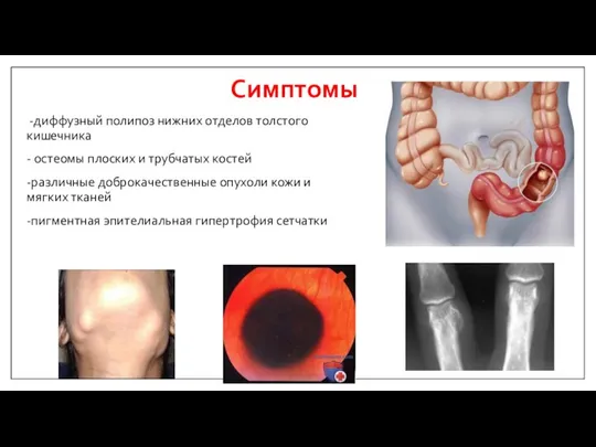 Симптомы -диффузный полипоз нижних отделов толстого кишечника - остеомы плоских и