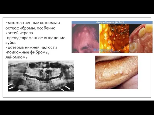 -множественные остеомы и остеофибромы, особенно костей черепа -преждевременное выпадение зубов -