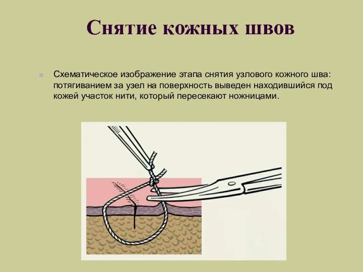 Снятие кожных швов Схематическое изображение этапа снятия узлового кожного шва: потягиванием