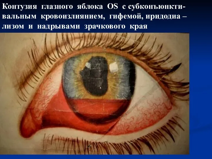 Контузия глазного яблока OS с субконъюнкти- вальным кровоизлиянием, гифемой, иридодиа –лизом и надрывами зрачкового края