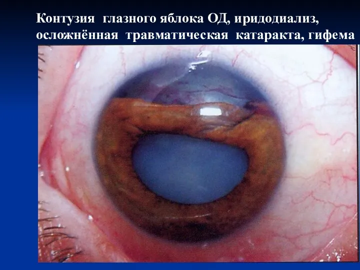 Контузия глазного яблока ОД, иридодиализ, осложнённая травматическая катаракта, гифема