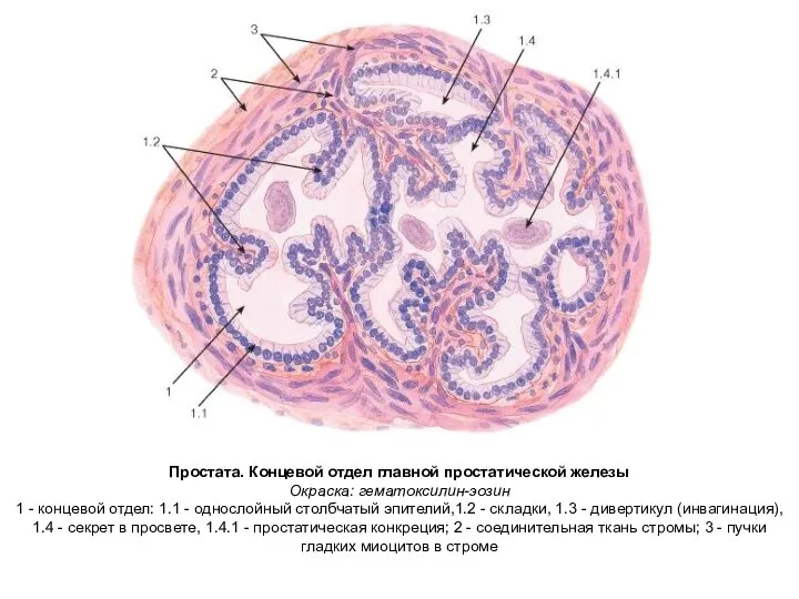 Простата. Концевой отдел главной простатической железы Окраска: гематоксилин-эозин 1 - концевой
