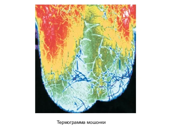 Термограмма мошонки