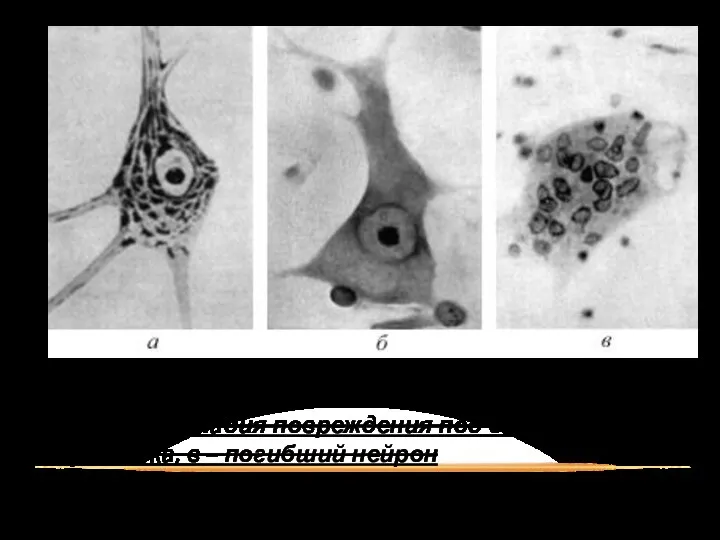 Разрушение нейрона: а – нормальный нейрон, б – начальная стадия повреждения