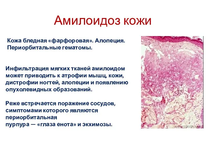 Амилоидоз кожи Инфильтрация мягких тканей амилоидом может приводить к атрофии мышц,