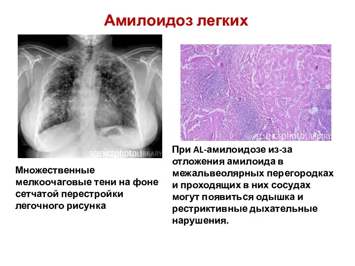 Амилоидоз легких Множественные мелкоочаговые тени на фоне сетчатой перестройки легочного рисунка