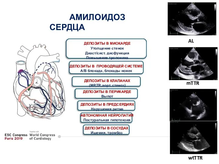 ДЕПОЗИТЫ В МИОКАРДЕ Утолщение стенок Диаст/сист. дисфункция Повышение тропонина ДЕПОЗИТЫ В