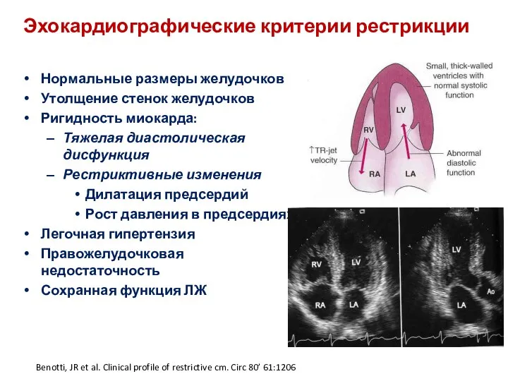 Эхокардиографические критерии рестрикции Нормальные размеры желудочков Утолщение стенок желудочков Ригидность миокарда: