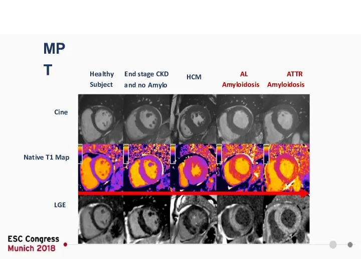 МРТ Healthy Subject Cine Native T1 Map LGE End stage CKD