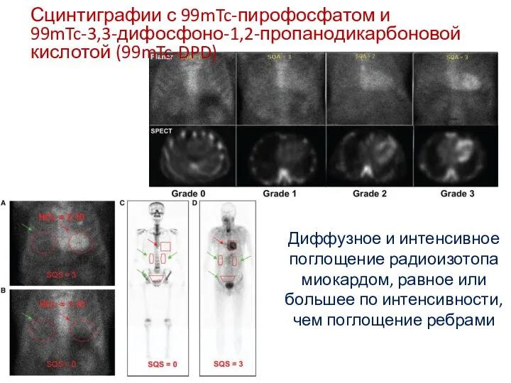 Сцинтиграфии с 99mTc-пирофосфатом и 99mTc-3,3-дифосфоно-1,2-пропанодикарбоновой кислотой (99mTc-DPD) Диффузное и интенсивное поглощение