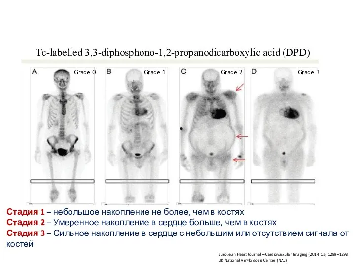 Tc-labelled 3,3-diphosphono-1,2-propanodicarboxylic acid (DPD) Grade 0 Grade 1 Grade 2 Grade