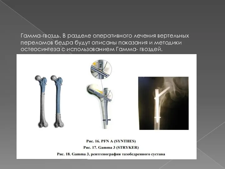 Гамма-гвоздь. В разделе оперативного лечения вертельных переломов бедра будут описаны показания