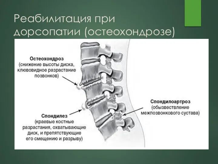 Реабилитация при дорсопатии (остеохондрозе)