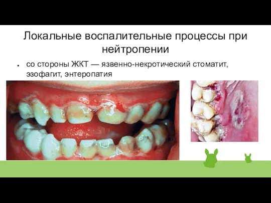 Локальные воспалительные процессы при нейтропении со стороны ЖКТ — язвенно-некротический стоматит, эзофагит, энтеропатия