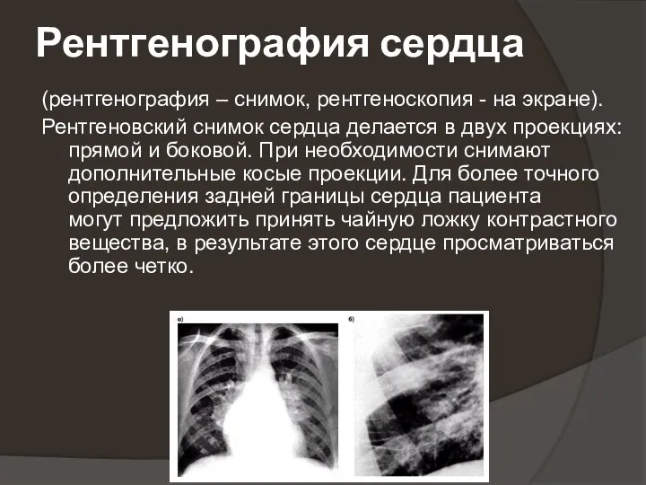 Рентгенография сердца (рентгенография – снимок, рентгеноскопия - на экране). Рентгеновский снимок