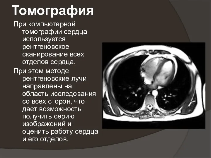 Томография При компьютерной томографии сердца используется рентгеновское сканирование всех отделов сердца.