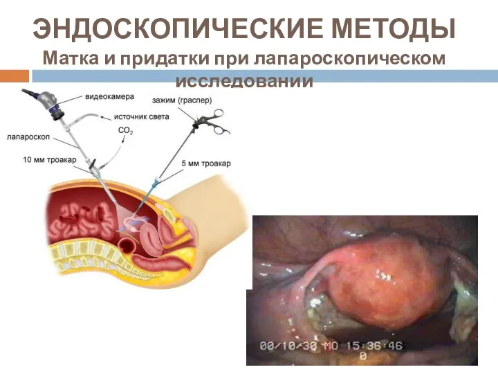 ЭНДОСКОПИЧЕСКИЕ МЕТОДЫ Матка и придатки при лапароскопическом исследовании