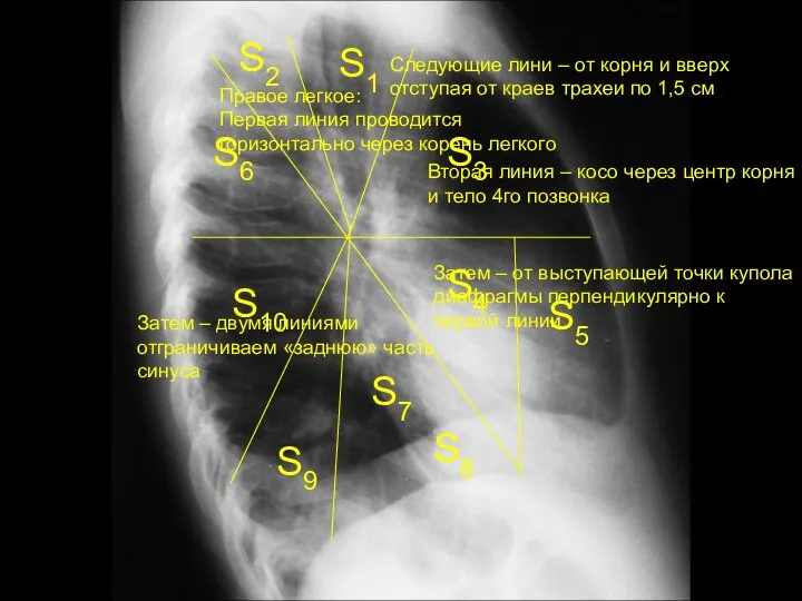 Правое легкое: Первая линия проводится горизонтально через корень легкого Вторая линия