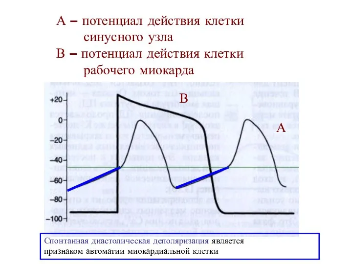 А – потенциал действия клетки синусного узла В – потенциал действия