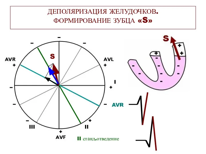 ДЕПОЛЯРИЗАЦИЯ ЖЕЛУДОЧКОВ. ФОРМИРОВАНИЕ ЗУБЦА «S» II станд.отведение AVR S