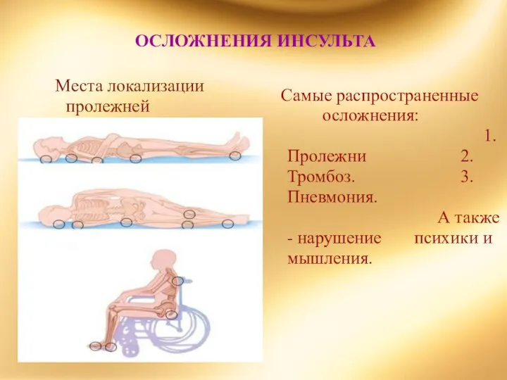 ОСЛОЖНЕНИЯ ИНСУЛЬТА Самые распространенные осложнения: 1. Пролежни 2. Тромбоз. 3. Пневмония.