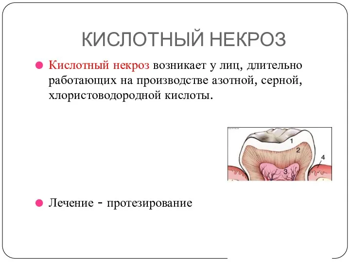 КИСЛОТНЫЙ НЕКРОЗ Кислотный некроз возникает у лиц, длительно работающих на производстве