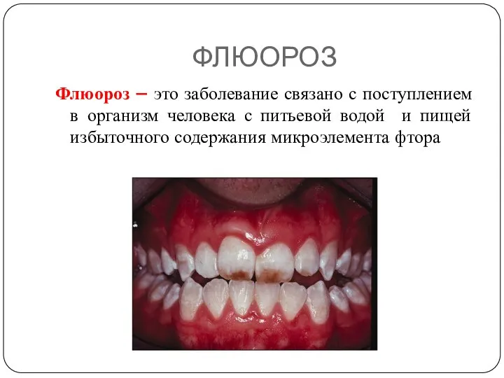 ФЛЮОРОЗ Флюороз – это заболевание связано с поступлением в организм человека