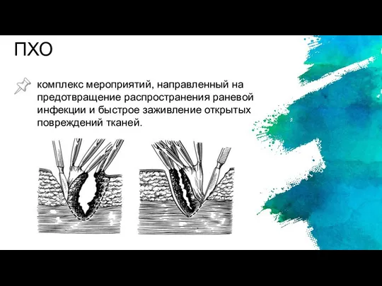 ПХО комплекс мероприятий, направленный на предотвращение распространения раневой инфекции и быстрое заживление открытых повреждений тканей.