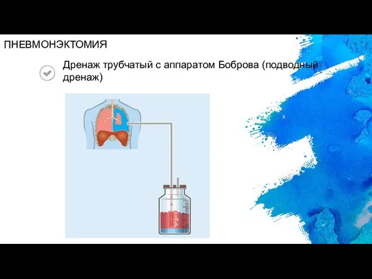 Дренаж трубчатый с аппаратом Боброва (подводный дренаж) ПНЕВМОНЭКТОМИЯ