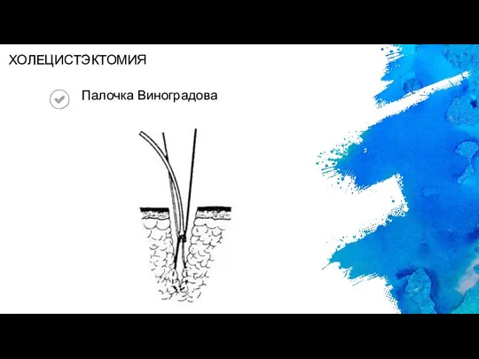 Палочка Виноградова ХОЛЕЦИСТЭКТОМИЯ