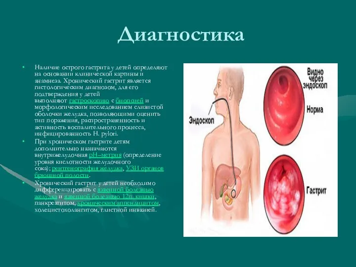 Диагностика Наличие острого гастрита у детей определяют на основании клинической картины