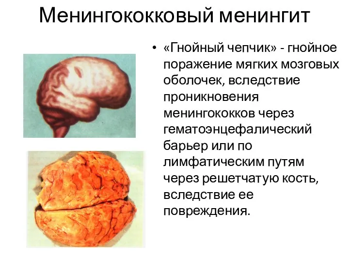 Менингококковый менингит «Гнойный чепчик» - гнойное поражение мягких мозговых оболочек, вследствие