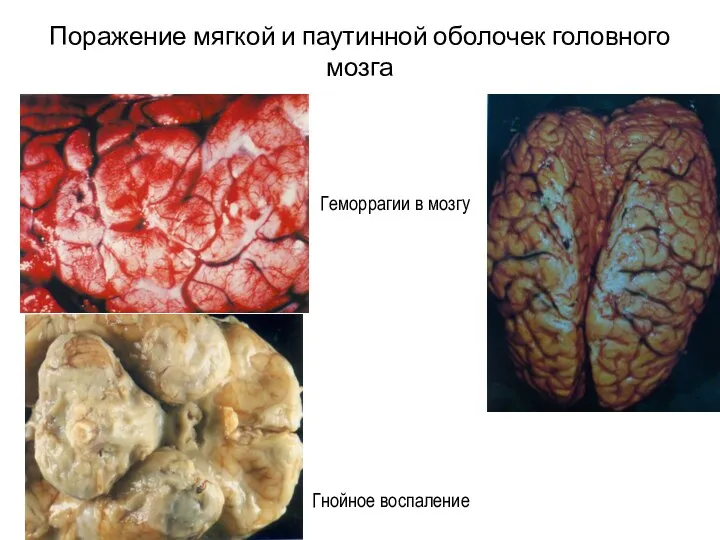 Поражение мягкой и паутинной оболочек головного мозга Гнойное воспаление Геморрагии в мозгу