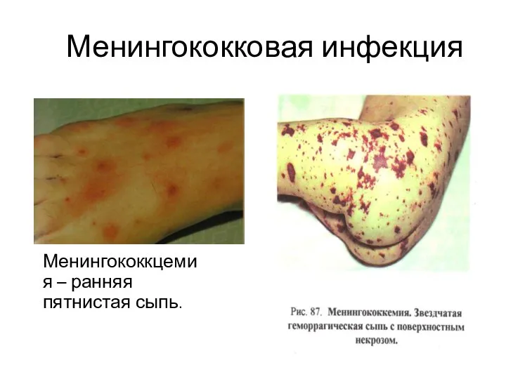 Менингококковая инфекция Менингококкцемия – ранняя пятнистая сыпь.