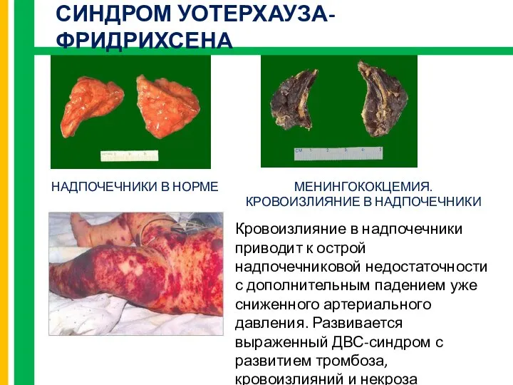 МЕНИНГОКОКЦЕМИЯ. КРОВОИЗЛИЯНИЕ В НАДПОЧЕЧНИКИ Кровоизлияние в надпочечники приводит к острой надпочечниковой